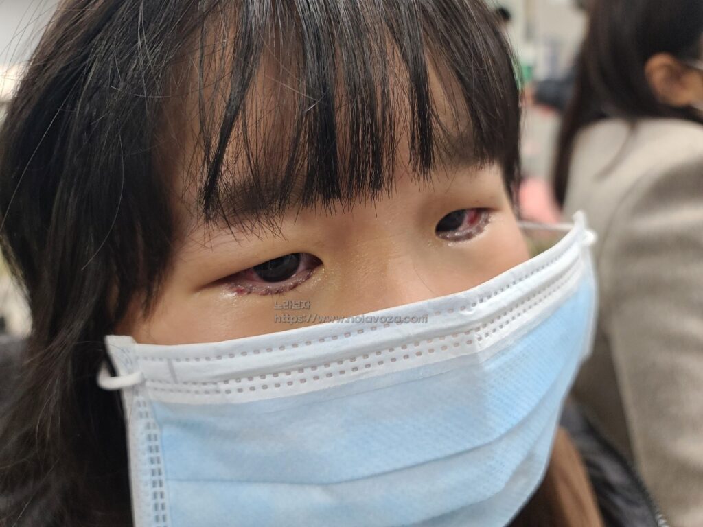 안검내반 수술 후 일주일 경과 상태